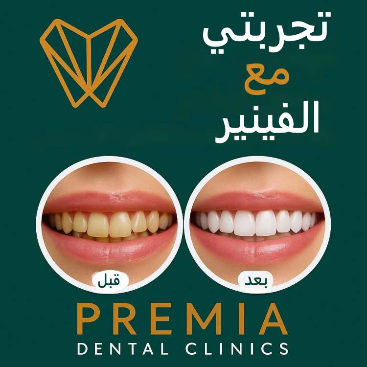 تجربتي مع الفينير