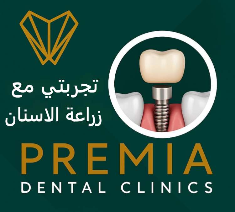 تجربتي مع زراعة الاسنان