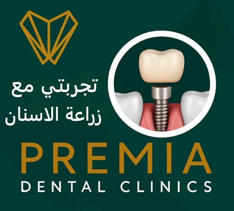 تفاصيل تجربتي مع زراعة الاسنان: هل الأمر يستحق حقاً؟