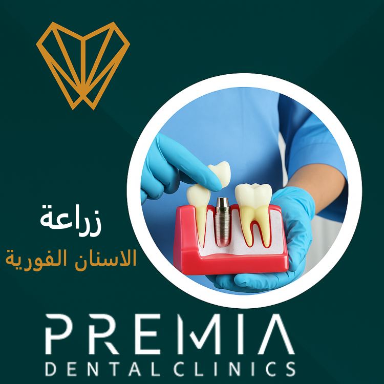 زراعة الاسنان الفورية