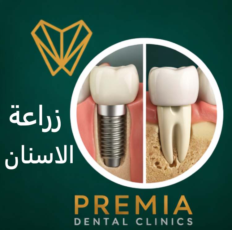 زراعة الاسنان ​| أحدث تقنيات التعويض الثابت للأسنان