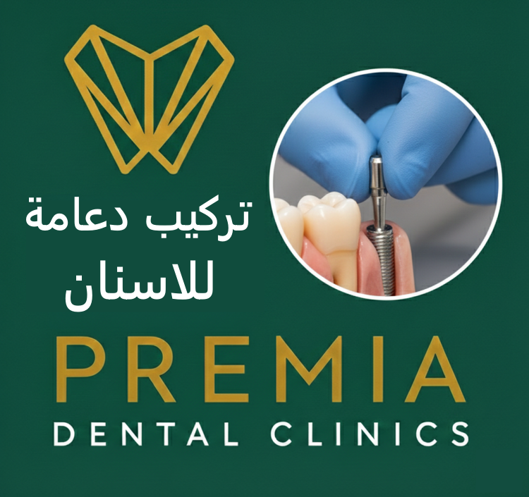 تركيب دعامة للاسنان | الخطوات والمدة والتكلفة