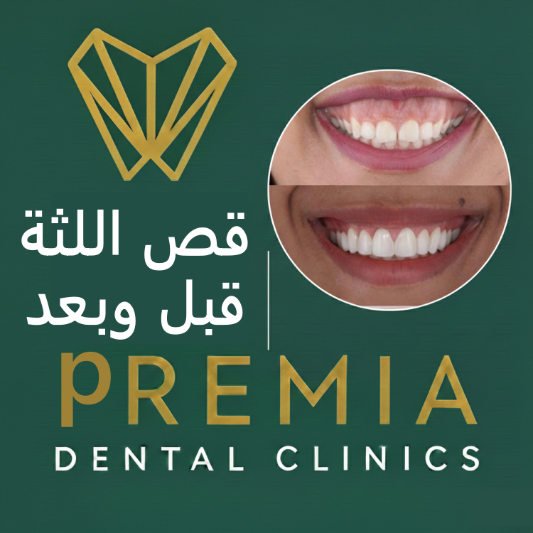 عملية قص اللثة قبل وبعد