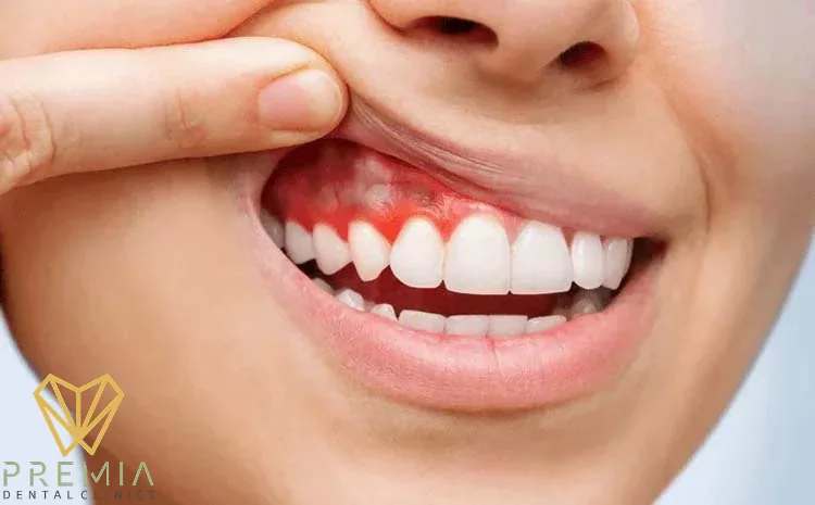 هل تورم اللثة خطير؟
