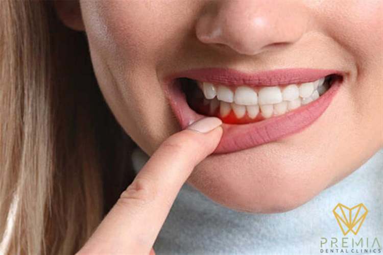 ما هي طرق علاج انتفاخ اللثة في الفك السفلي؟