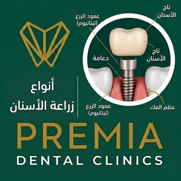 انواع زراعة الاسنان | دليل شامل قبل الاختيار