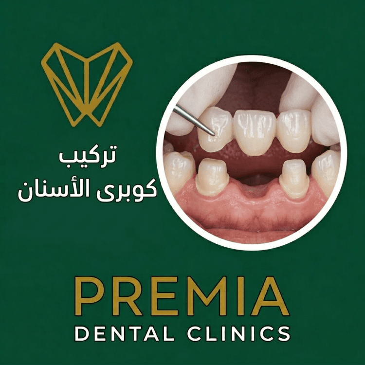تركيب كوبرى الاسنان | التكلفة والفرق بين الأنواع