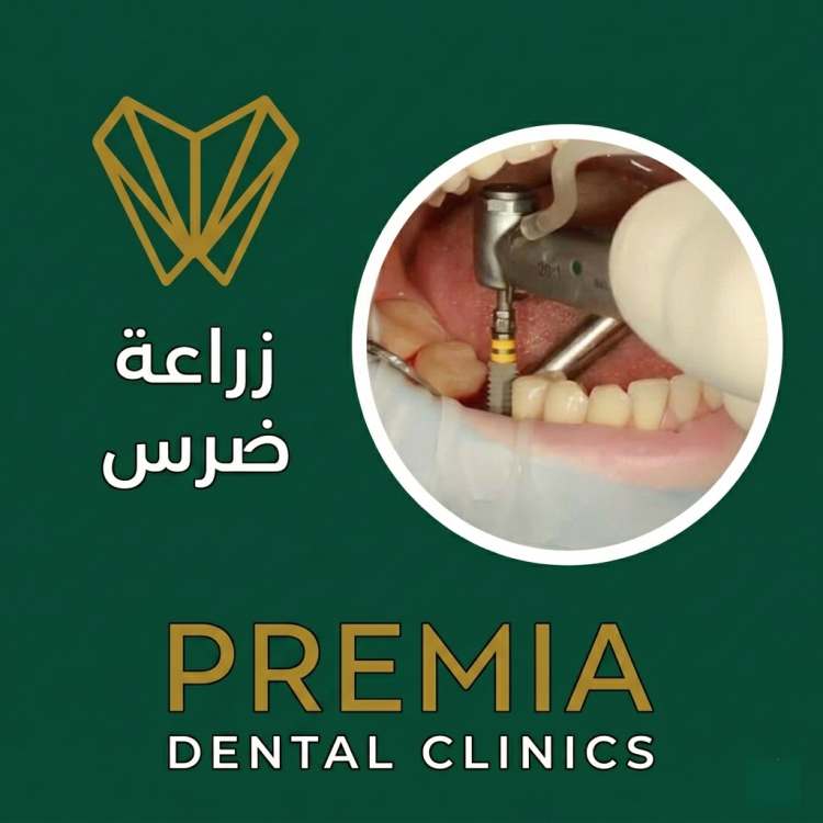 زراعة ضرس | هل هي الحل الافضل لتعويض الضرس