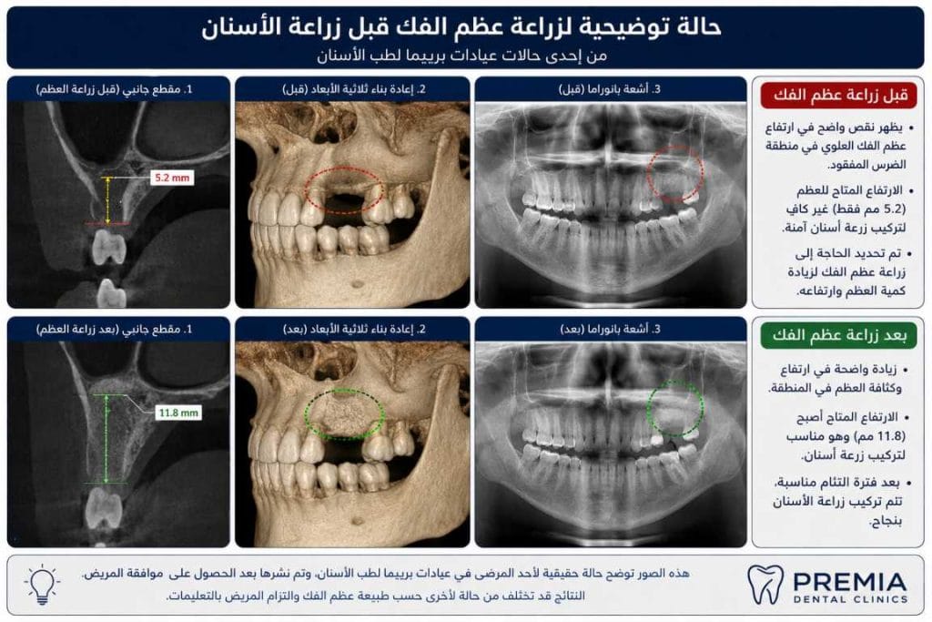 مراحل زراعة عظام الفك